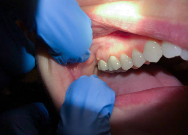 Best Broken or Chipped Tooth Repair in Erwin, NC